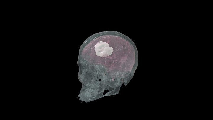 Mózg z gózem [CT-MRI] 3D Model