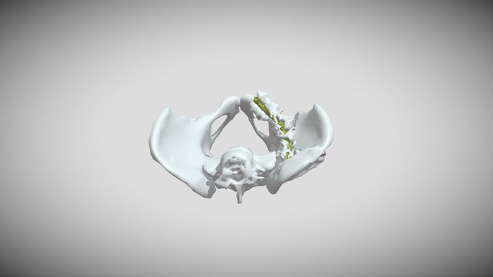 PELVIC FRACTURE & HARDWARE 3D Model