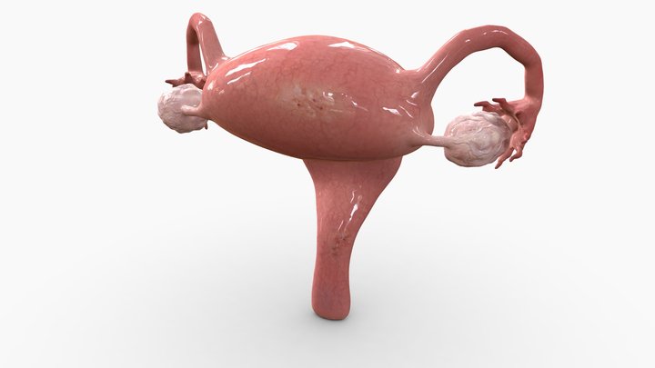 Uterus with Endometriosis 3D Model