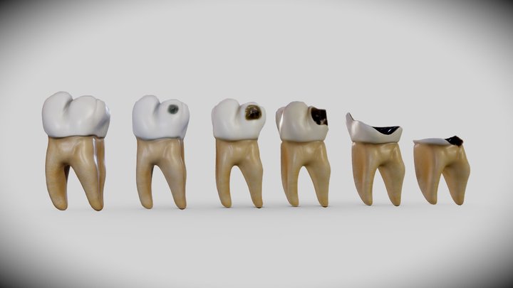 Tooth decay progression (Dental caries) 3D Model