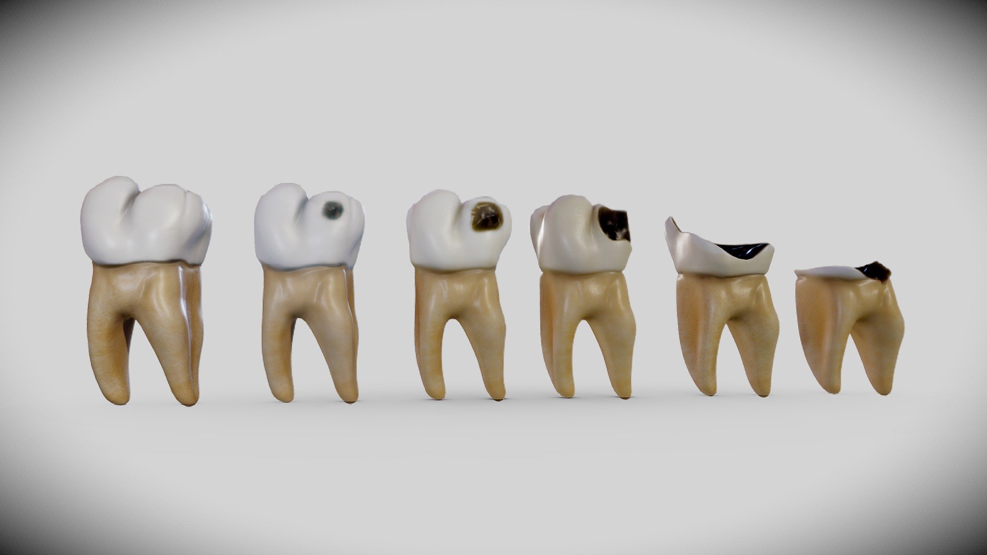 Tooth Decay Progression Dental Caries Buy Royalty Free 3d Model By