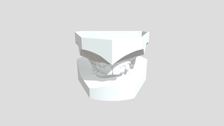 98246567_ABO_lockedocclusion_ul 3D Model
