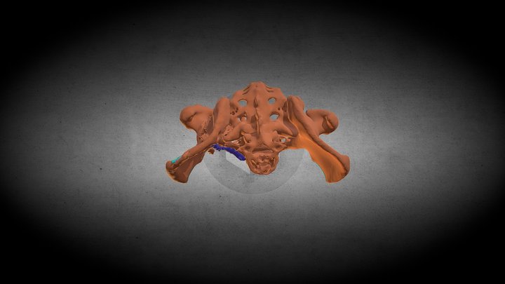 Surgical hip repair 3D Model