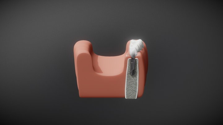 Dental Implant 3D Model