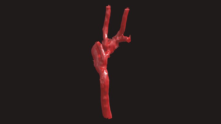Coartación aórtica - Siameses 3D Model