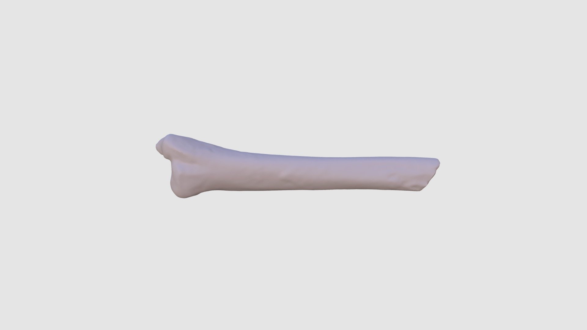 U.W. 88-21 Distal tibia