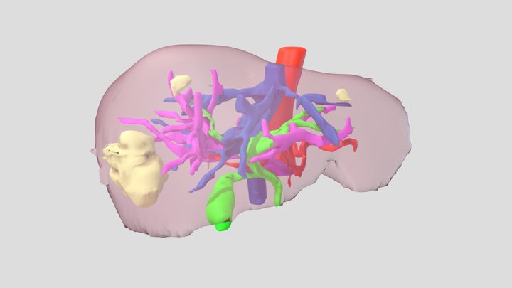 Liver with segment 5/8 tumour 3D Model