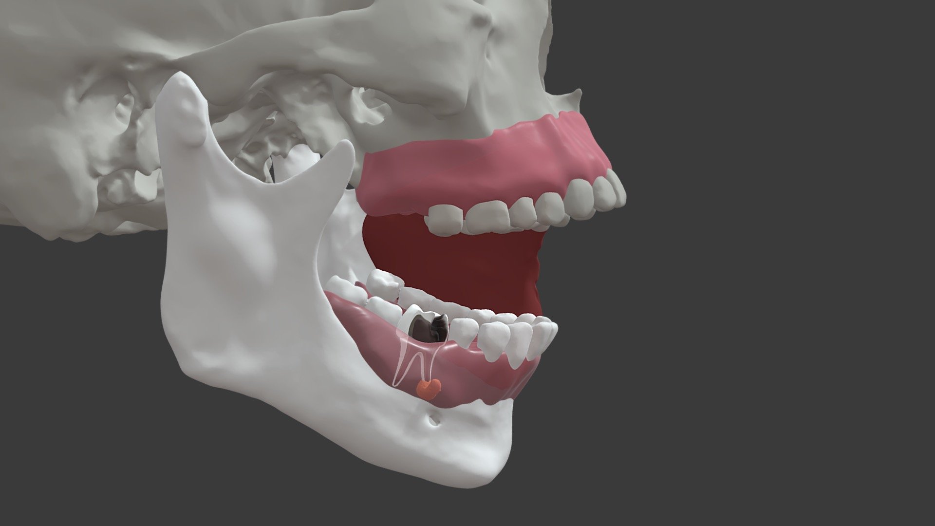 Stage- 4 Mandibular molar infection pathway 1 - 3D model by University ...