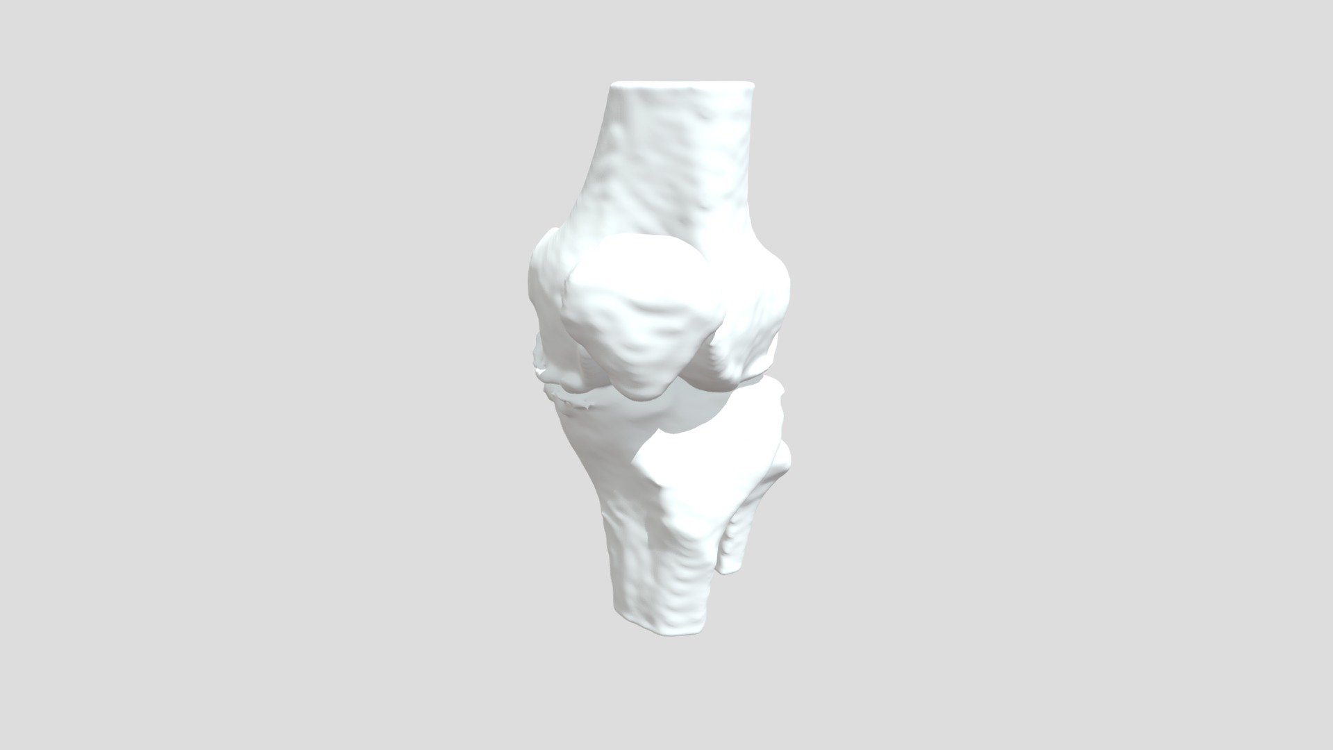 Segmentation Div Tri Lt Bone