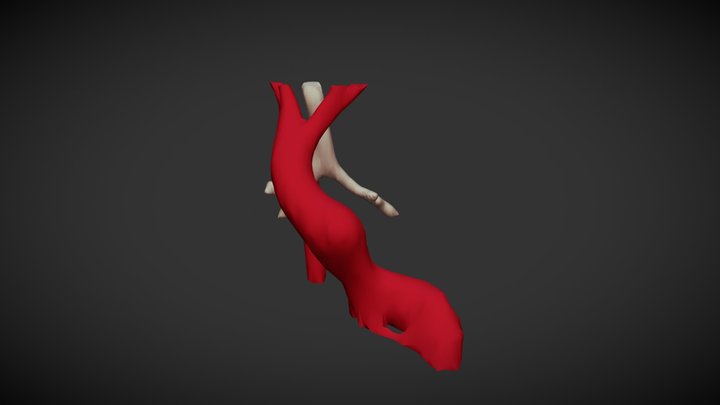 Right aortic arch with mirror branching 3D Model