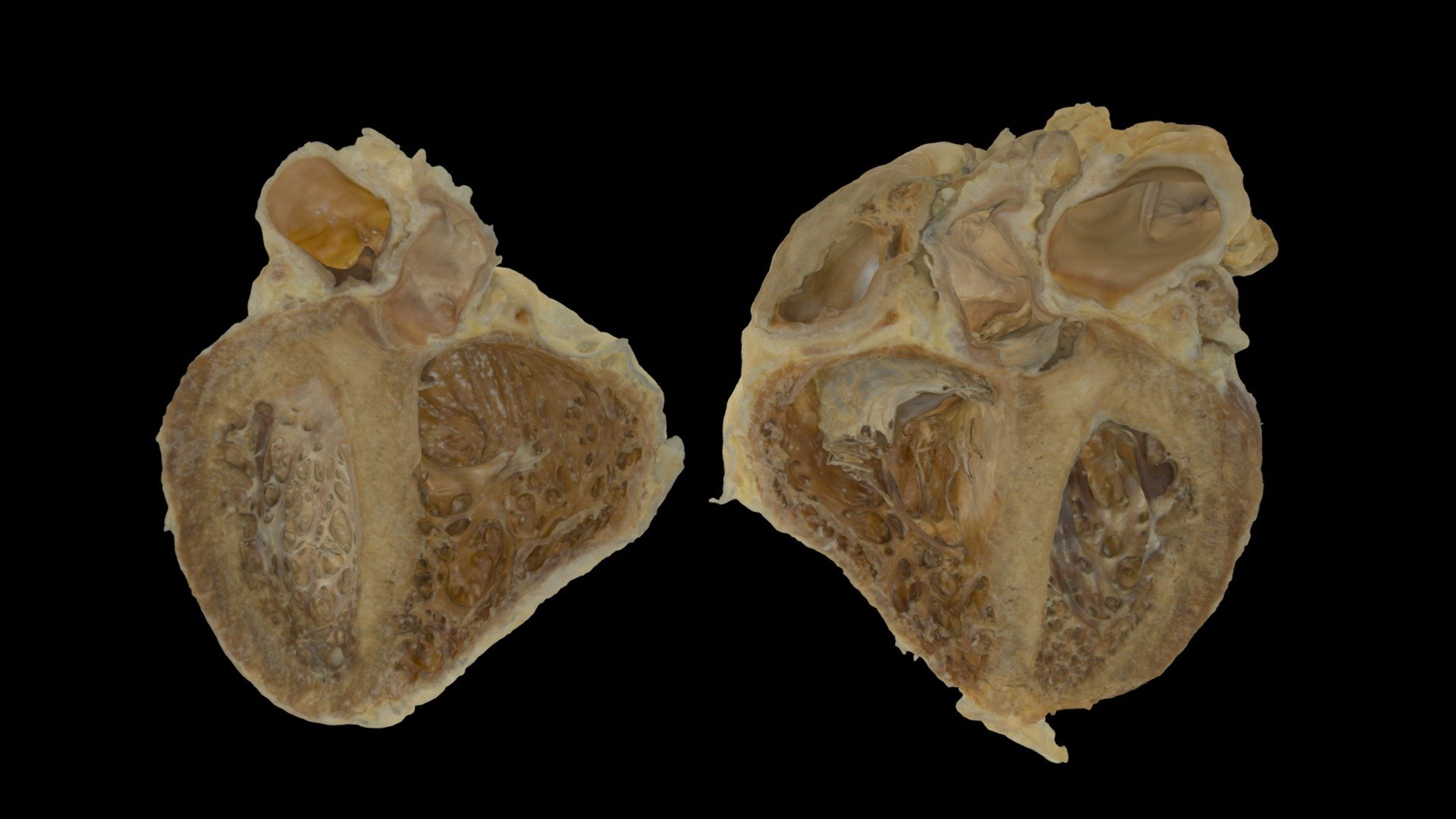 Plastinated Hypertensive Heart0126