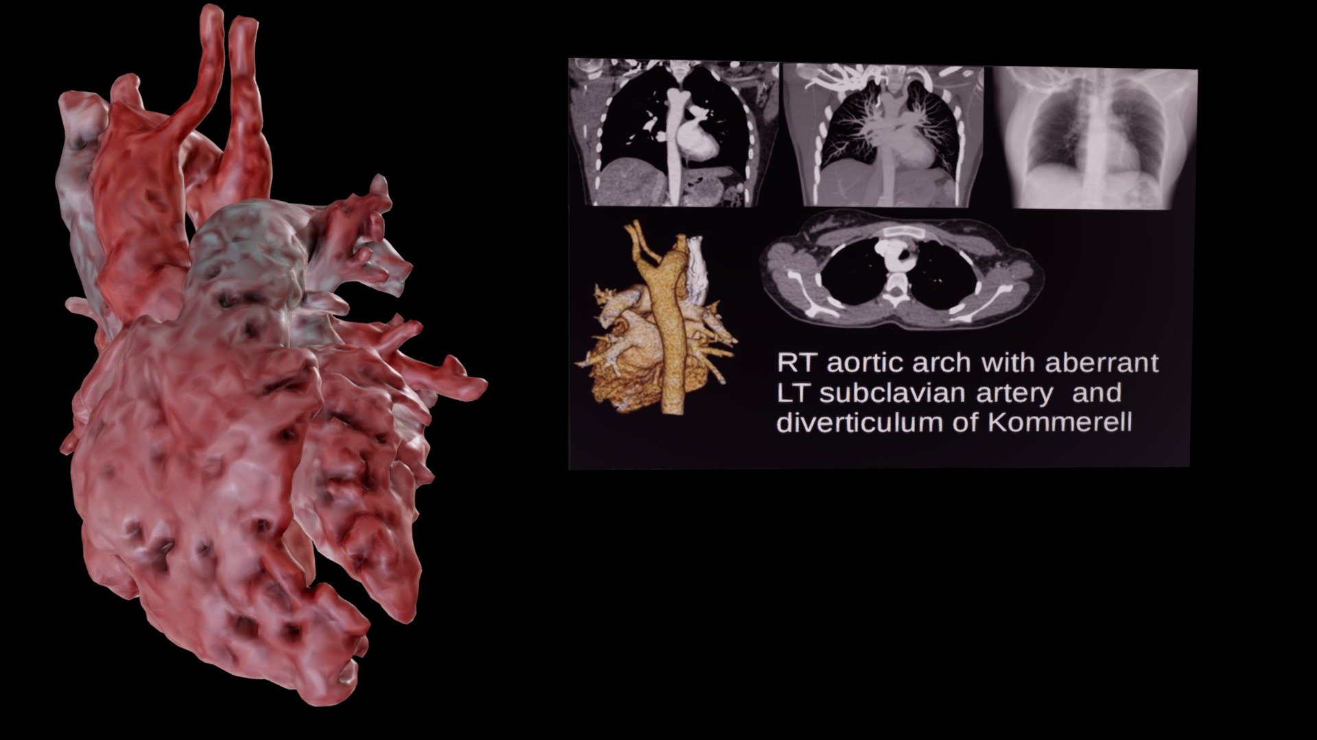 RT Aortic Arch with Aberrant LT Subclavian