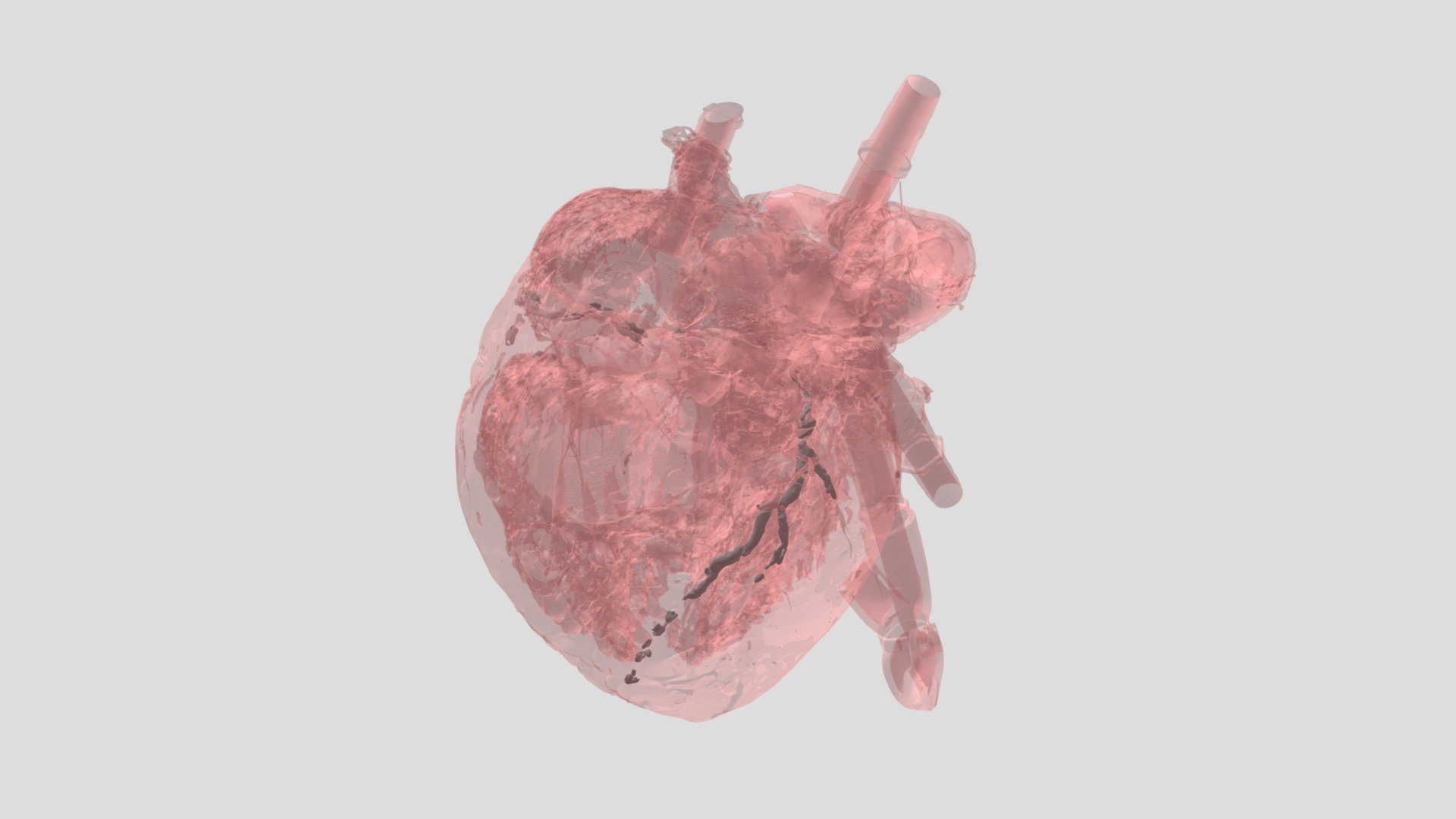 CAD Calcification: HH0624 - Download Free 3D model by VisibleHeartLabs ...