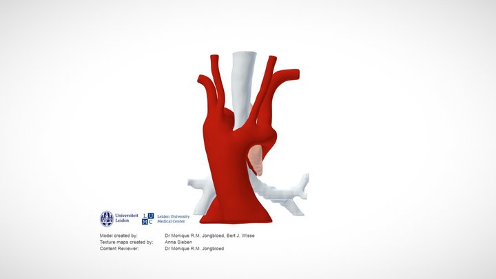 Double aortic arch incl. trachea