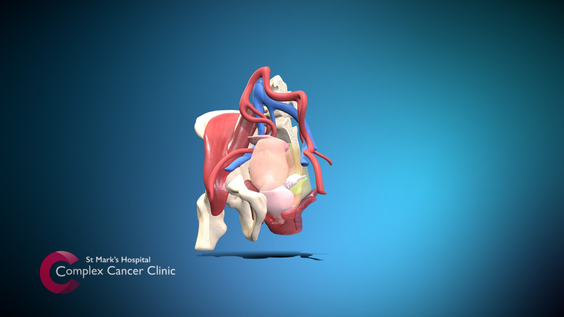 Rectal cancer- Exenteration