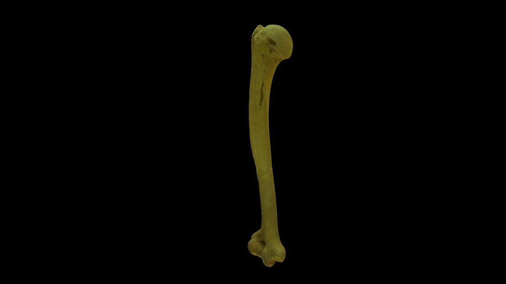 Retroversión humeral severa - 3D model by F Cortés (@fondecy1151203 ...