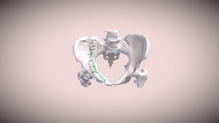 Exam 3 Individual Pelvis Segmentation - Gilmore 3D Model