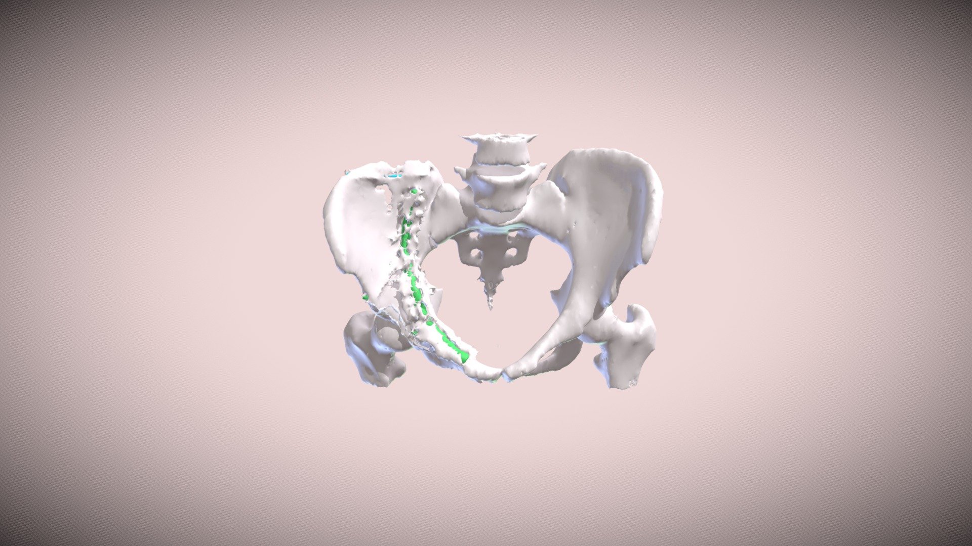 Exam 3 Individual Pelvis Segmentation - Gilmore