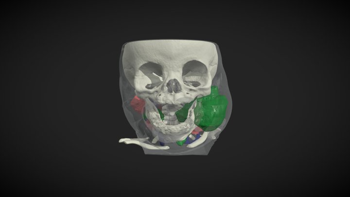 Lymphatic Malformation Neck and Face 3D Model