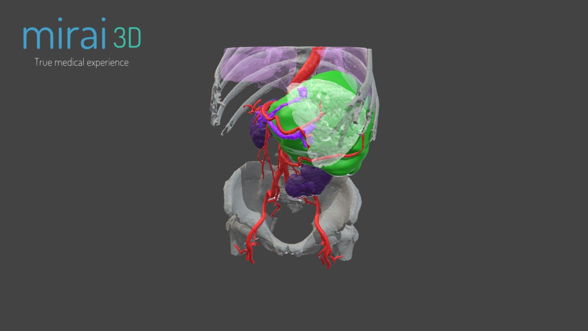 Tumor gigante - HPB