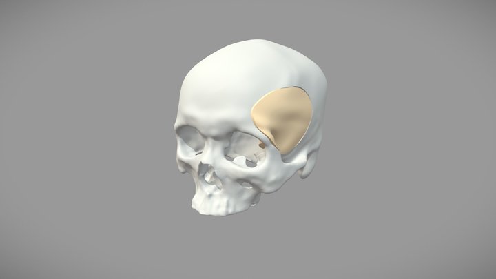 3D打印颅颌面修复系统 3D Model