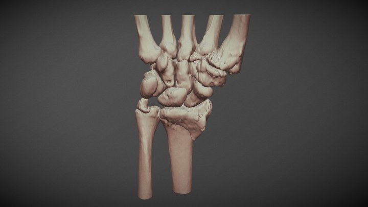 Generic fracture of the wrist 3D Model
