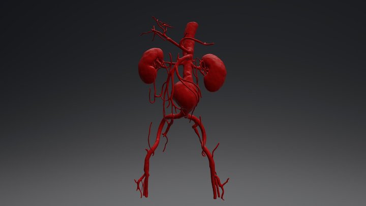 Abdominal aorta aneurism – Free 3D Model STL