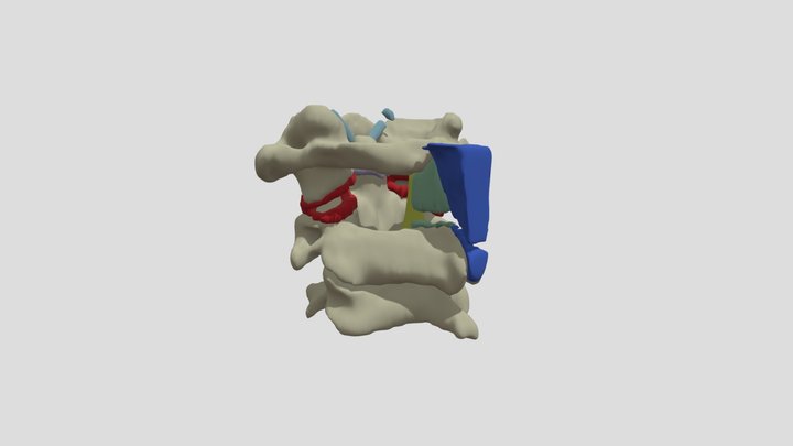 Atlantoaxial Dissociation C1-C2 3D Model