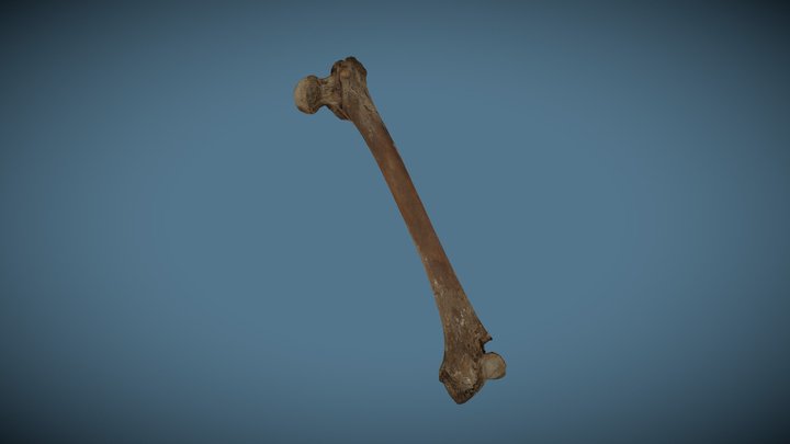 PGV3157 Left Femur Hip Fracture 3D Model