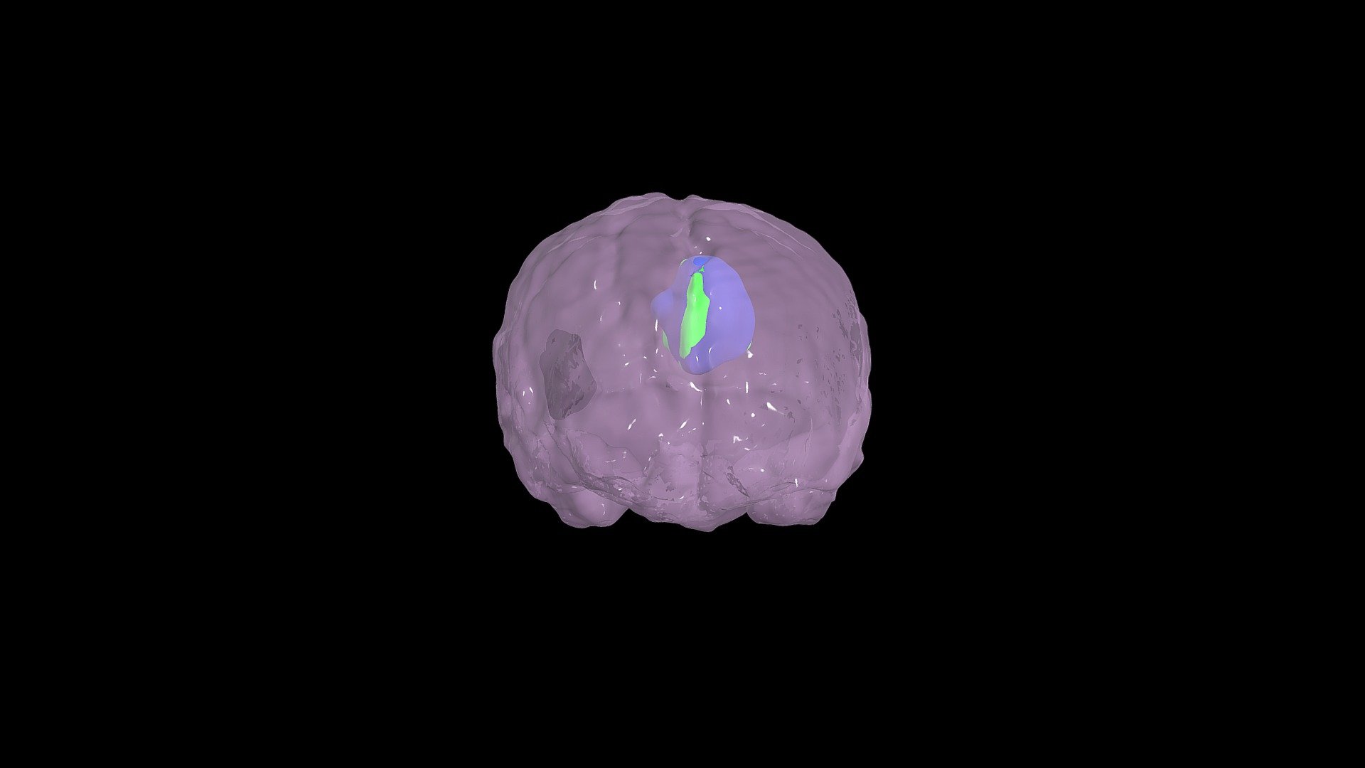 Brain and Tumors (2 Different Time Points)