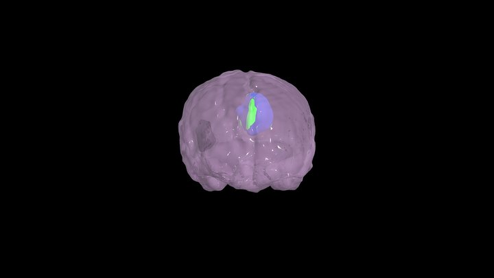 Brain and Tumors (2 Different Time Points) 3D Model