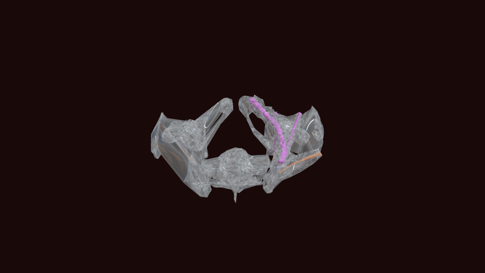 Pelvis and Hardware