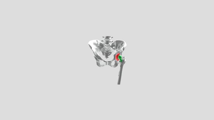Hüft-Endoprothese nach 27 Jahren 3D Model