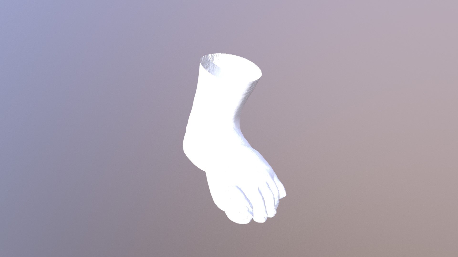 Podiatrist - Diabetic Charcot Foot with MPP - 3D model by ...