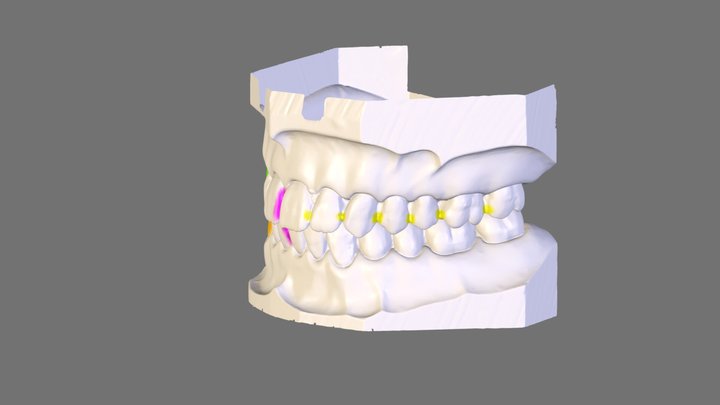 Oclusão normal 3D Model