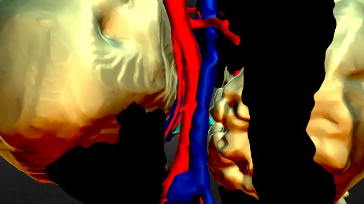 PRE_SURGERY_HUVH_Radiology_Dr.Riera_Rds 3D Model