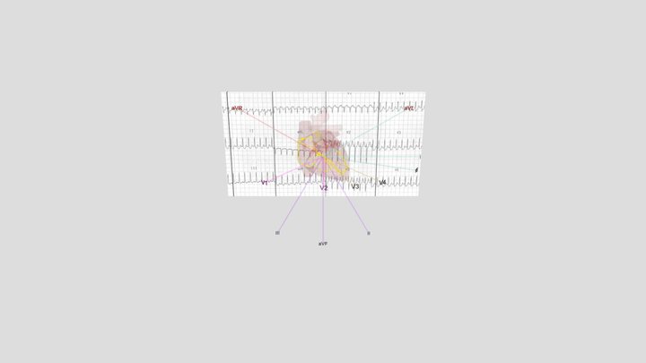Orthodromic AVRT synced with ECG 3D Model