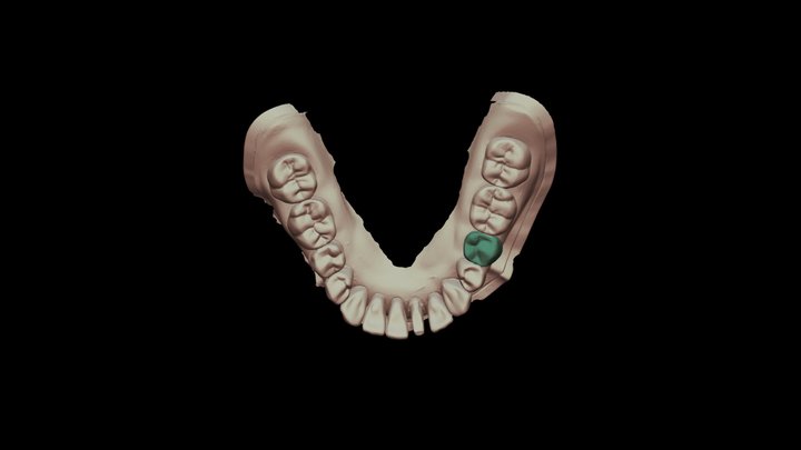 (Upperclassman) #20 on Dentoform 3D Model