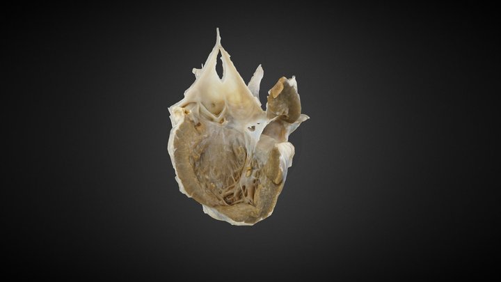 108 - VSD/Aortic Valve Prolapse 3D Model