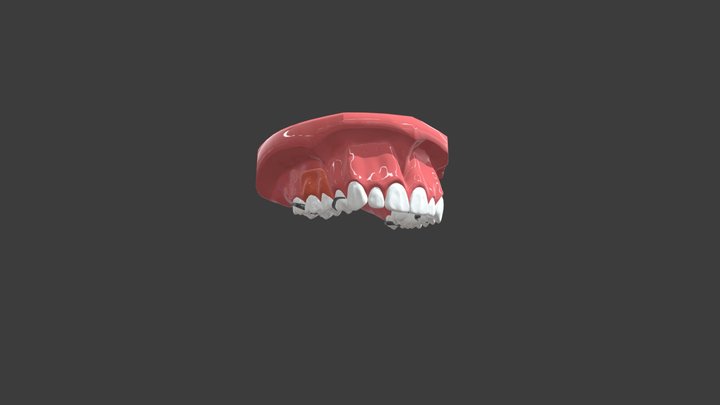 Maxillary RPD insertion animation 3D Model