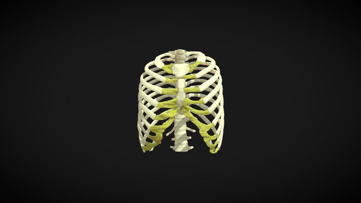 Pectus excavatum case 3D Model