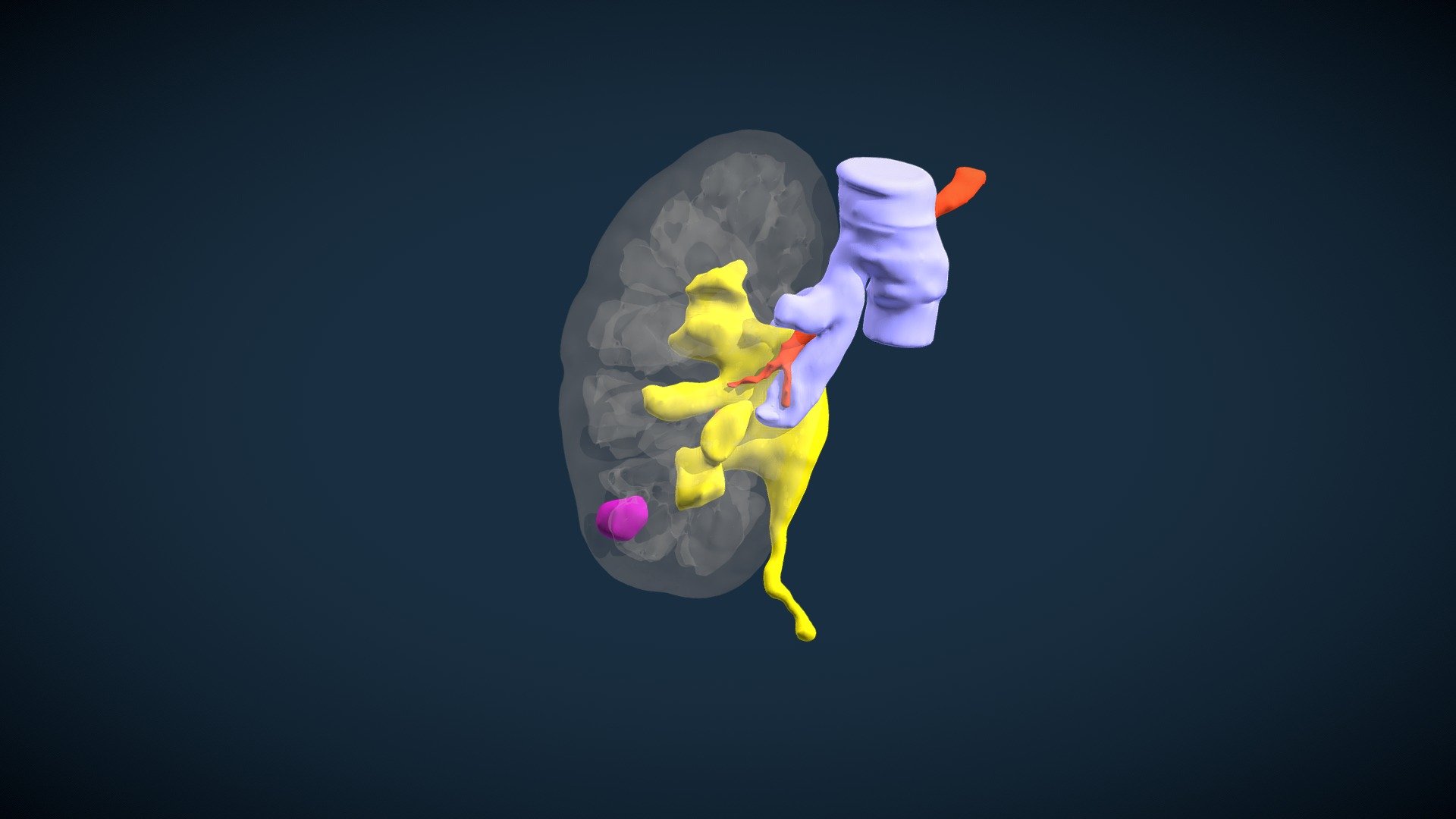Right renal tumor (P.M.M.G.)