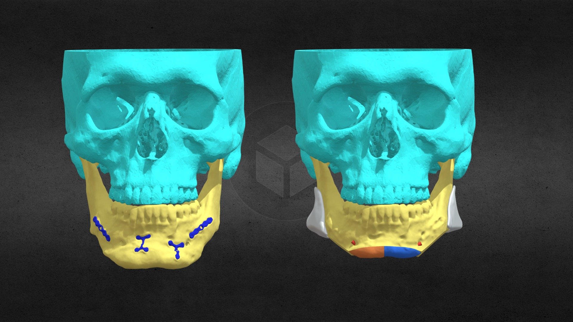 Remodelación mandibular con implantes - 3D model by johnnyuday [555ad6f ...