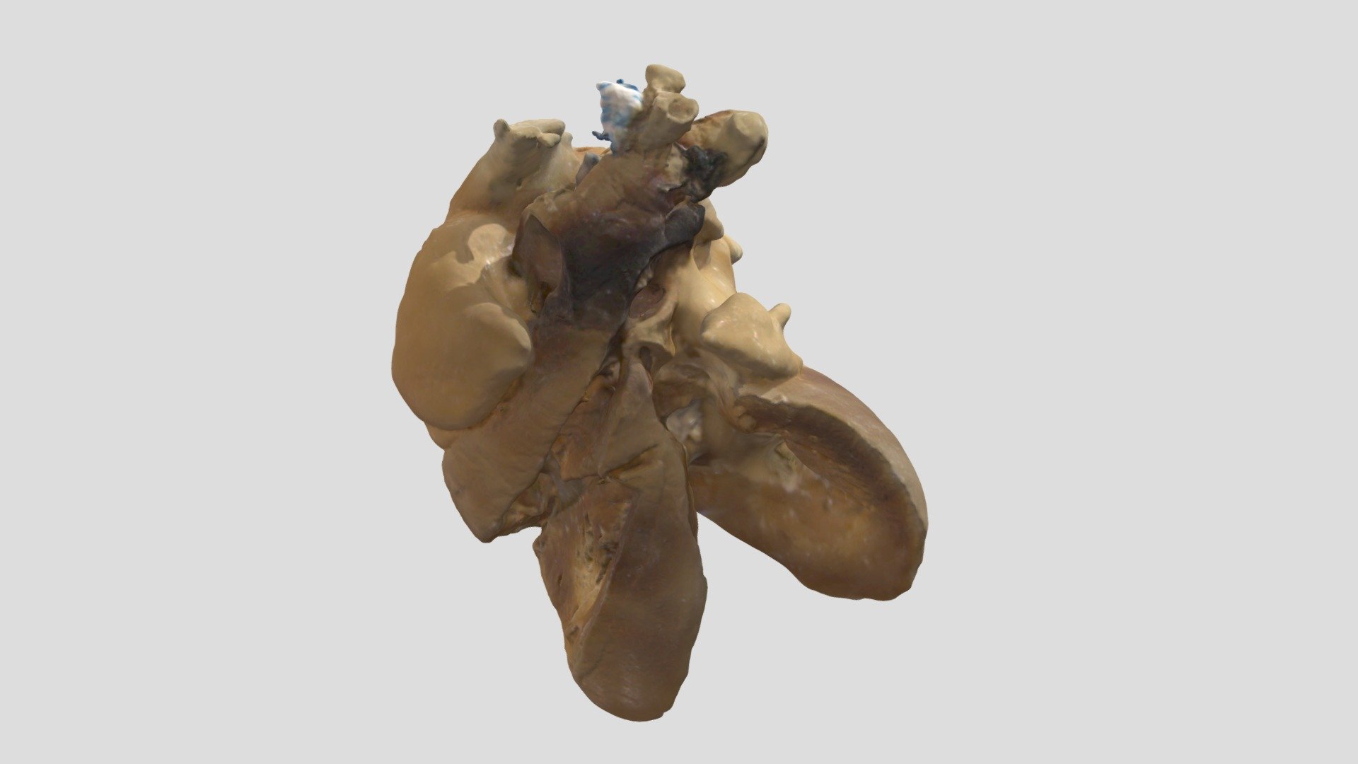 Tricuspid Atresia_A8159