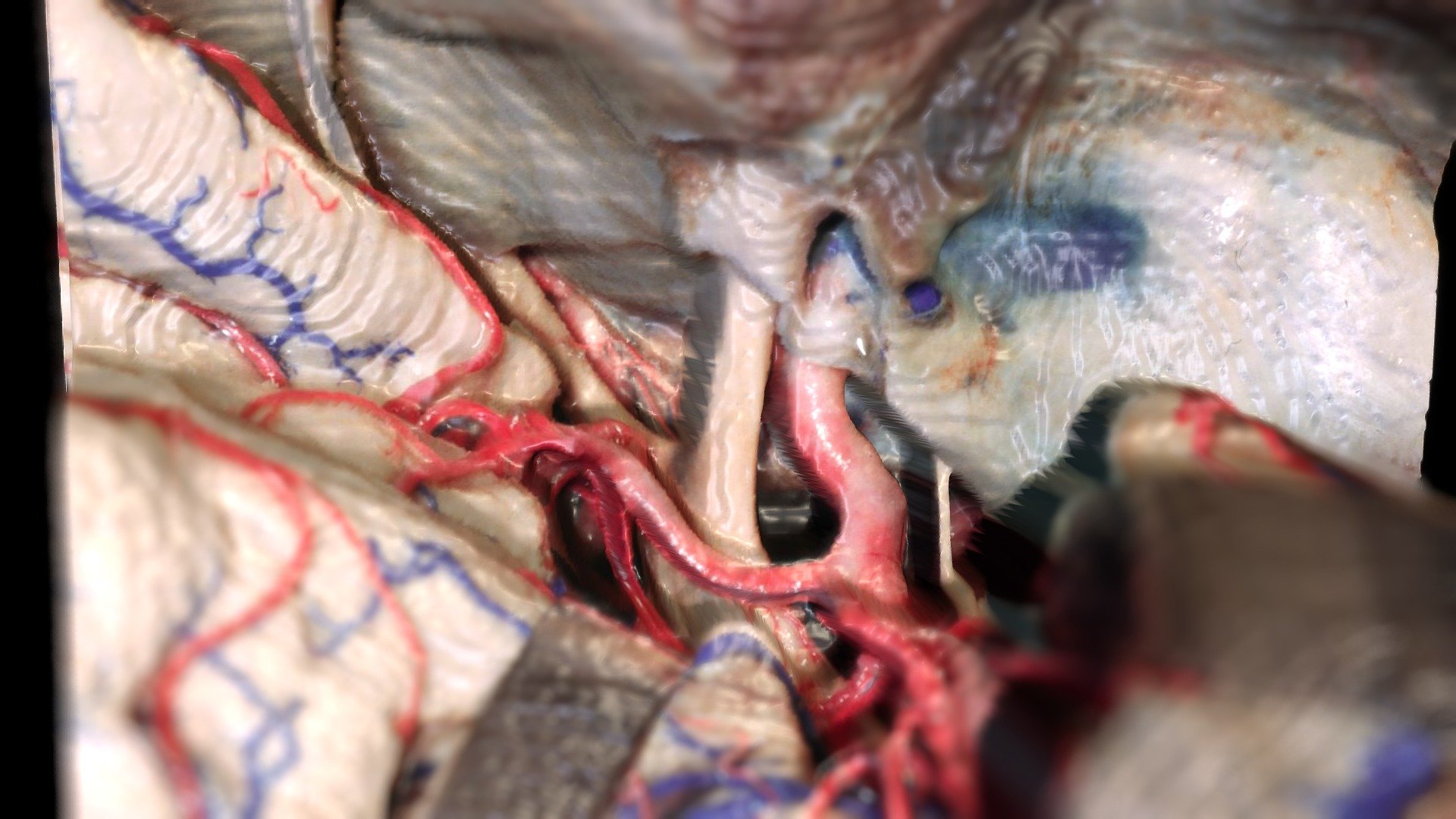Rhoton Collection: Orbitozygomatic approach