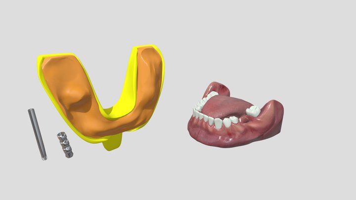 Open tray implant impression 3D Model