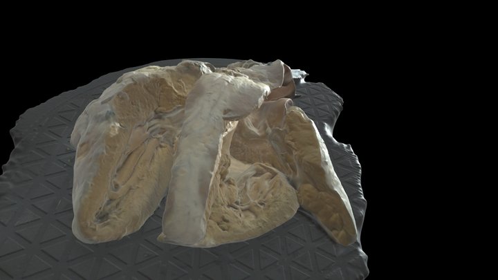Congenitally 3D models - Sketchfab