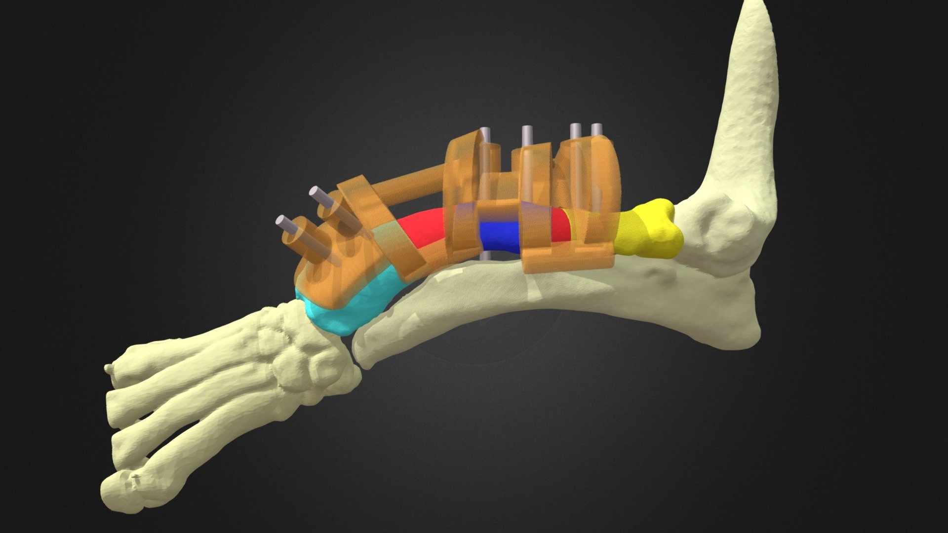 Osteotomy guide for antebrachial deformity 3D model by johnnyuday