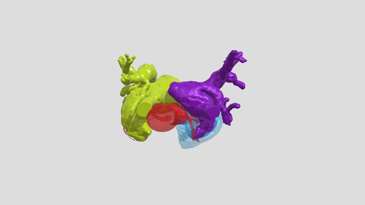 Raghib and Scimitar Syndrome 3D Model