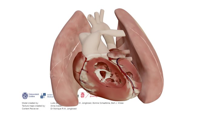 Transposition of the great arteries after switch – Modello 3D gratuito STL